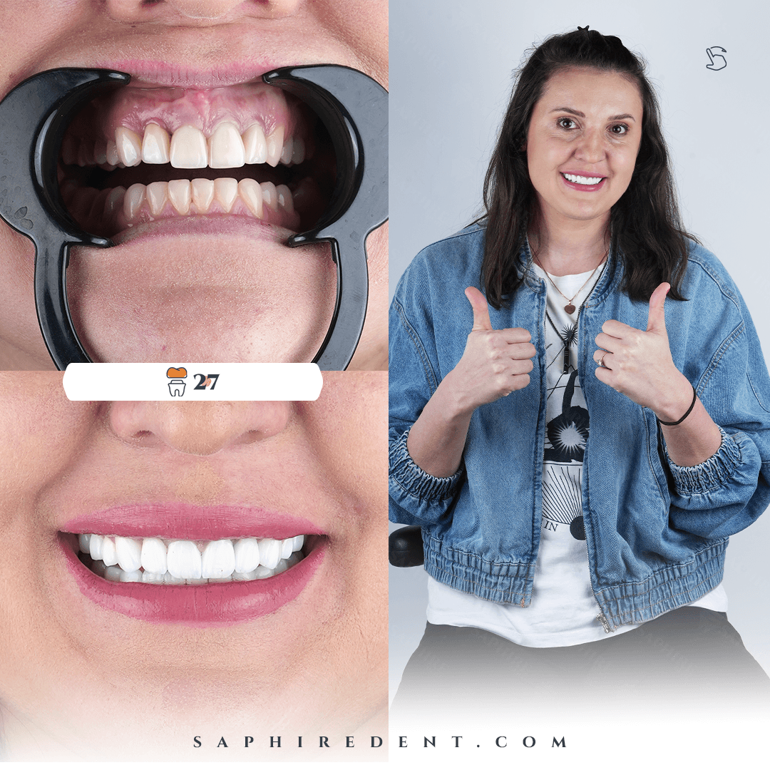 Nano Oxide Dental Crowns
