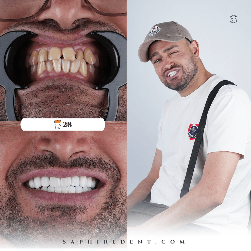 Veneers