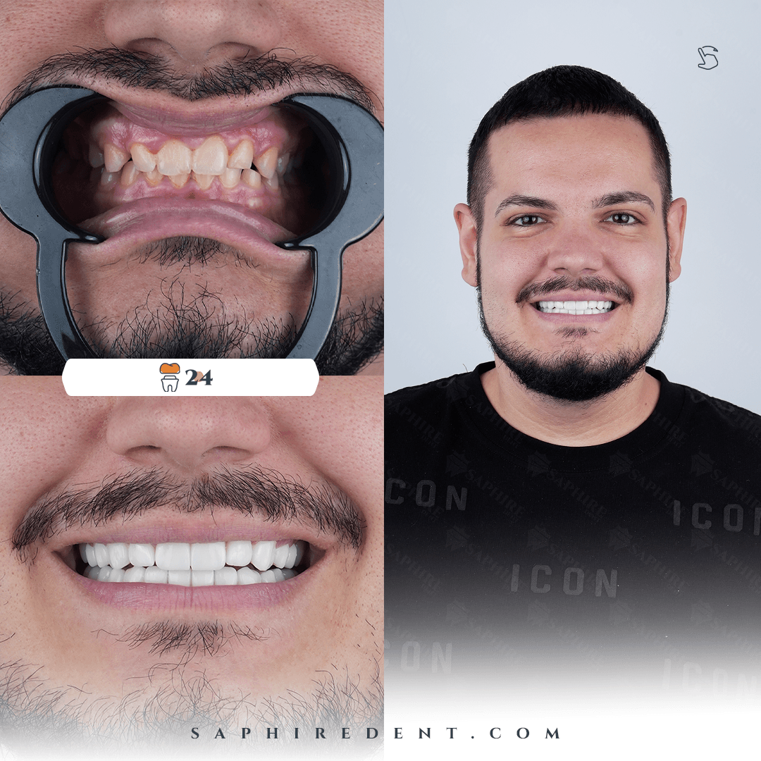 veneers.customDesign