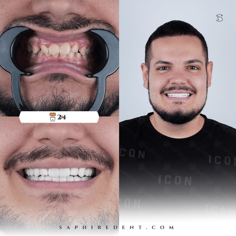 Veneers