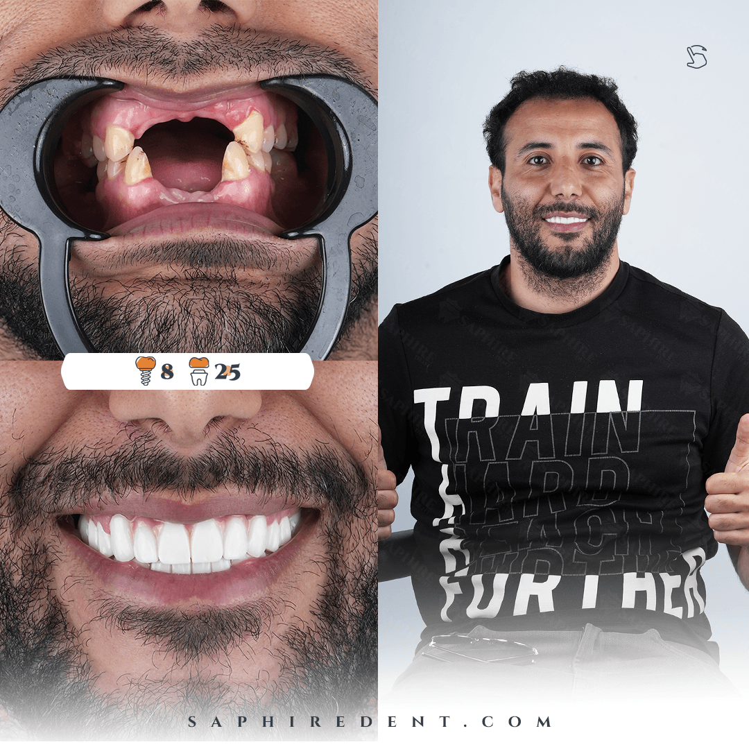 Patient with dental implants - before and after transformation