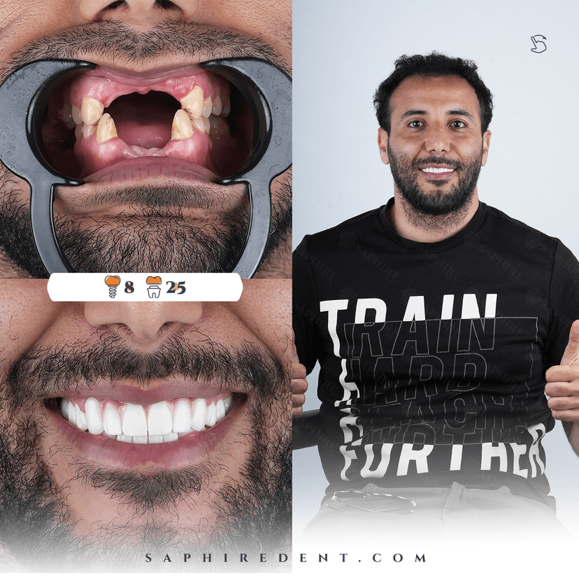 Dental Implants