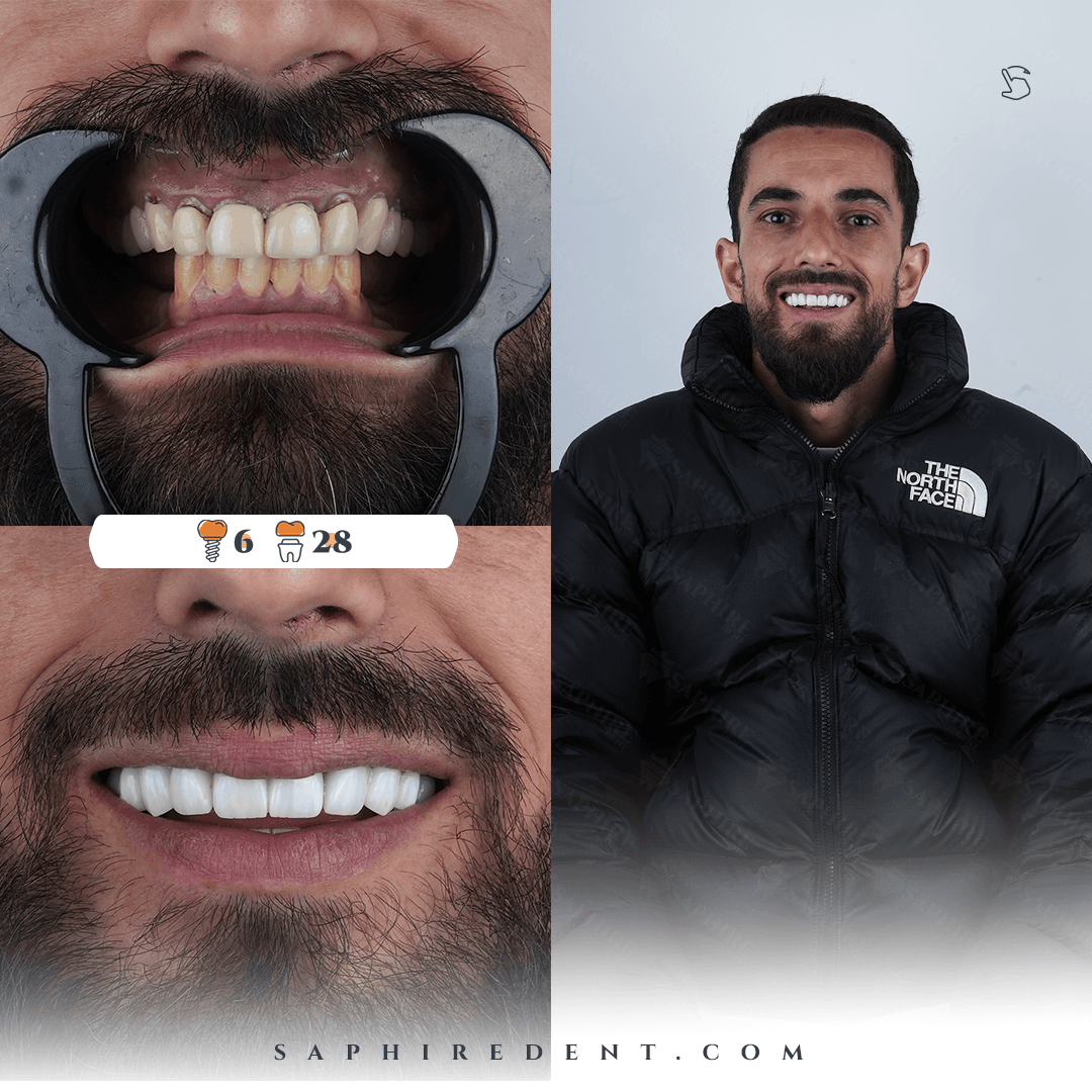 dentalImplants.transformation12