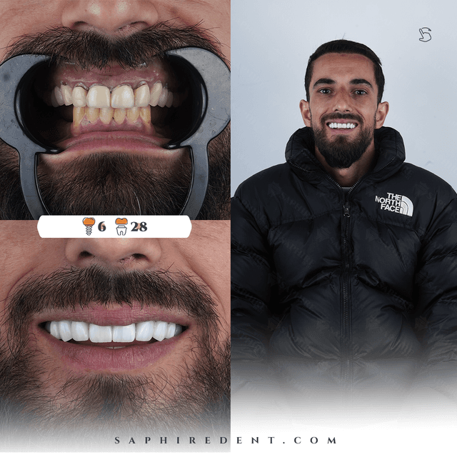 Dental Implants