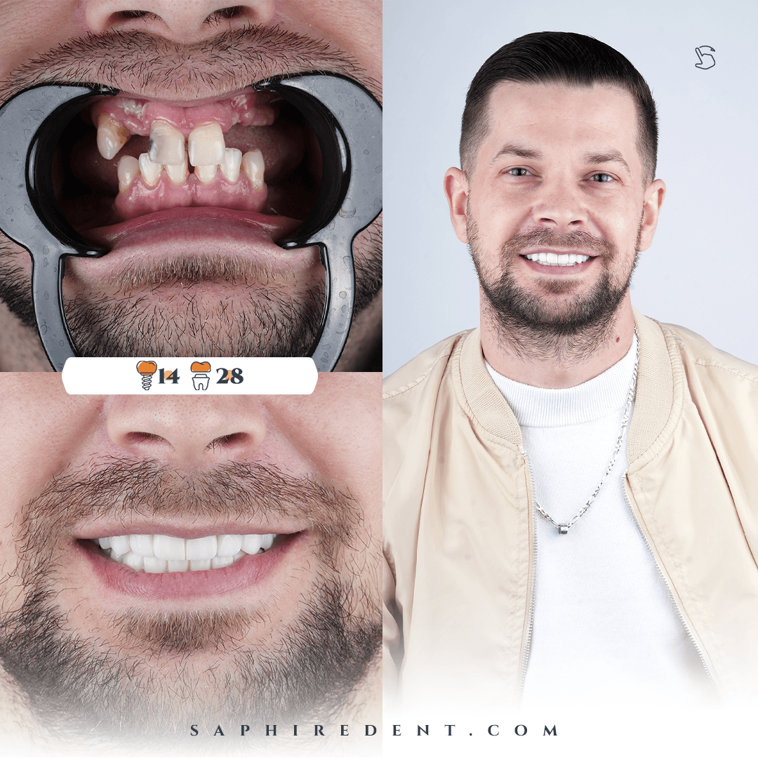 dentalImplants.multipleRestoration