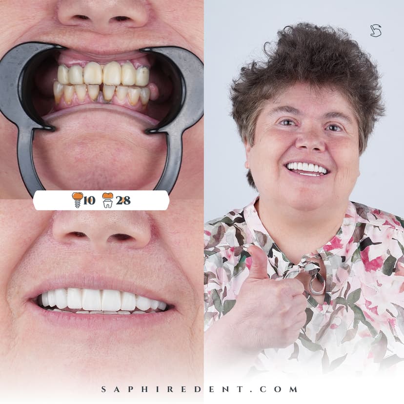 Hollywood Smile