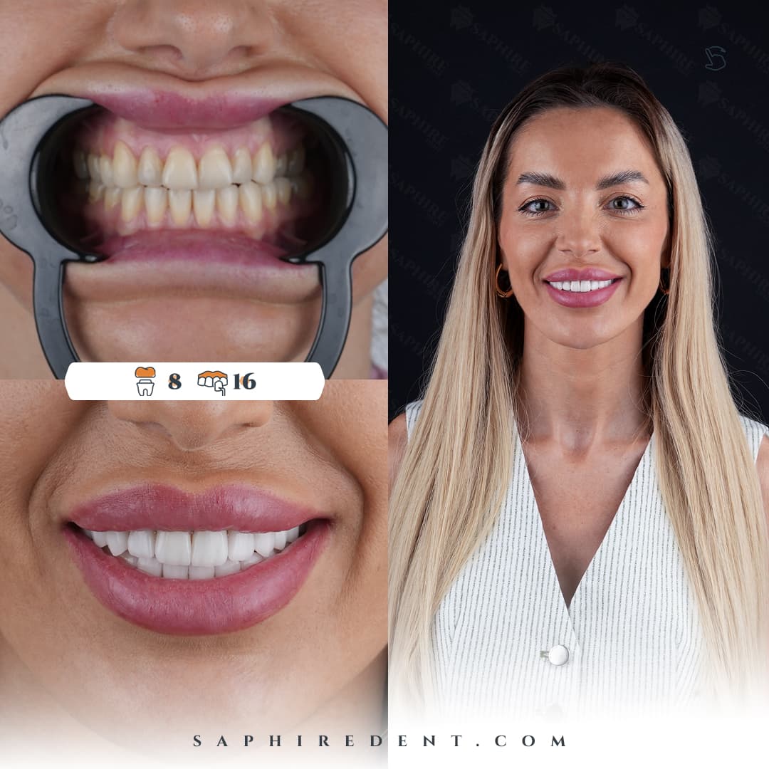 hollywoodSmile.transformation