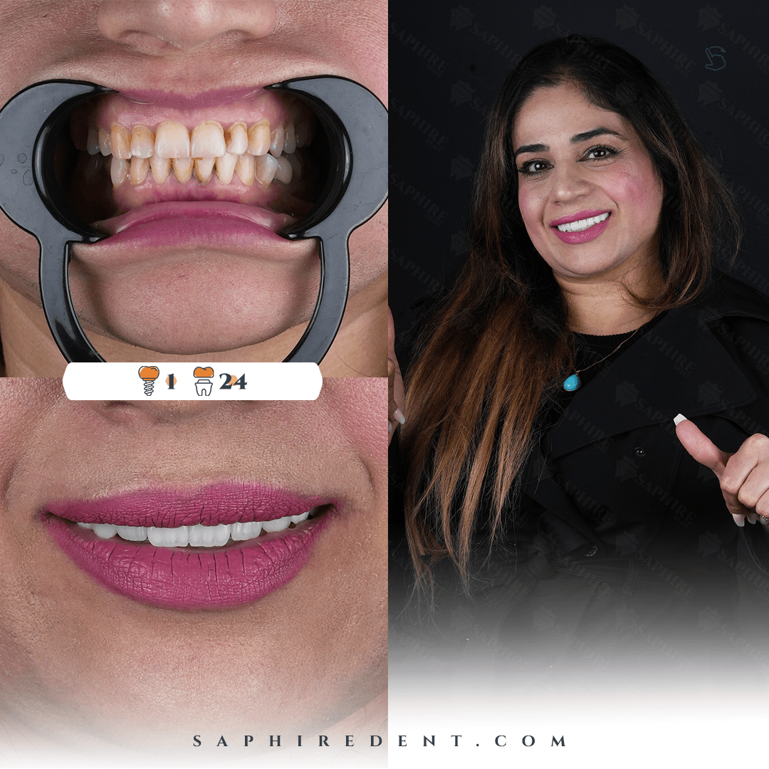 hollywoodSmile.premiumDesign