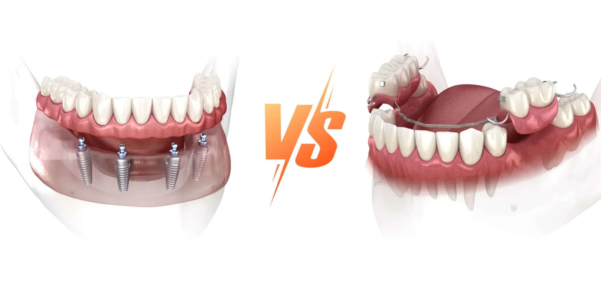 Implants vs. Prothèses : Quel Choix Correspond à Votre Mode de Vie ?