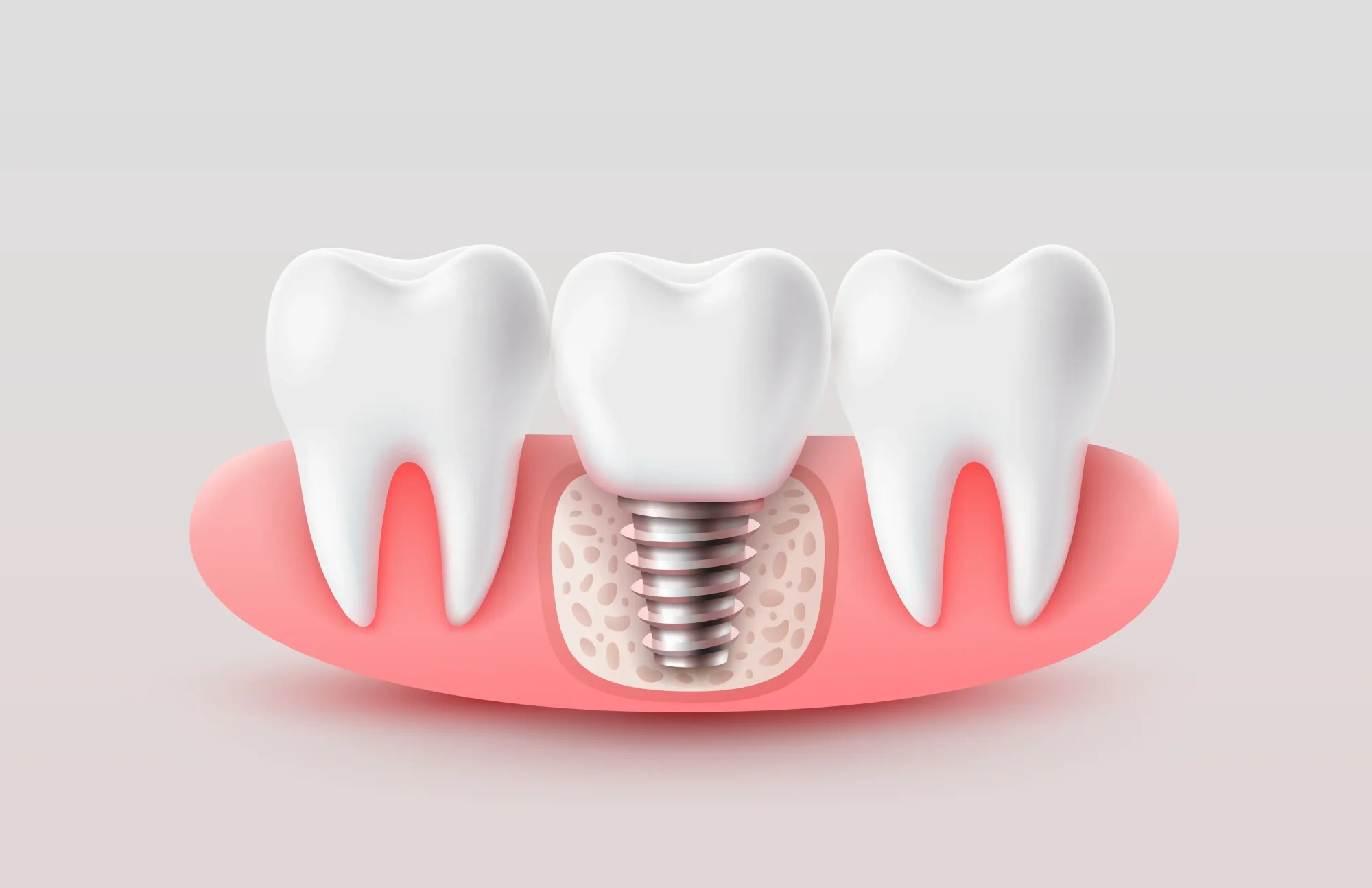 The Secret to Bone Health: Why Implants Are Better for Your Jaw Than Bridges