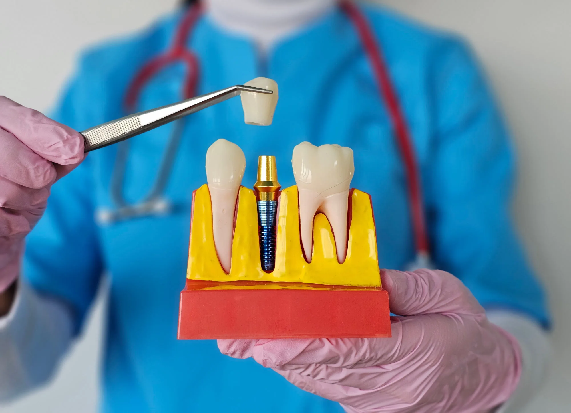 Implants vs. Dentures: Which Choice is Right for Your Lifestyle?