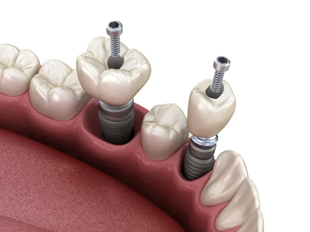Are You a Candidate for Dental Implants in Turkey?
