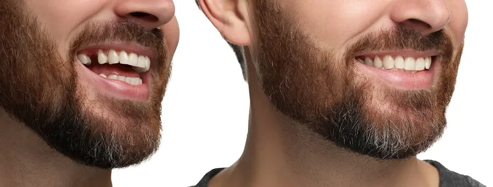 A New Smile, Built to Last: Dental Implants in Istanbul