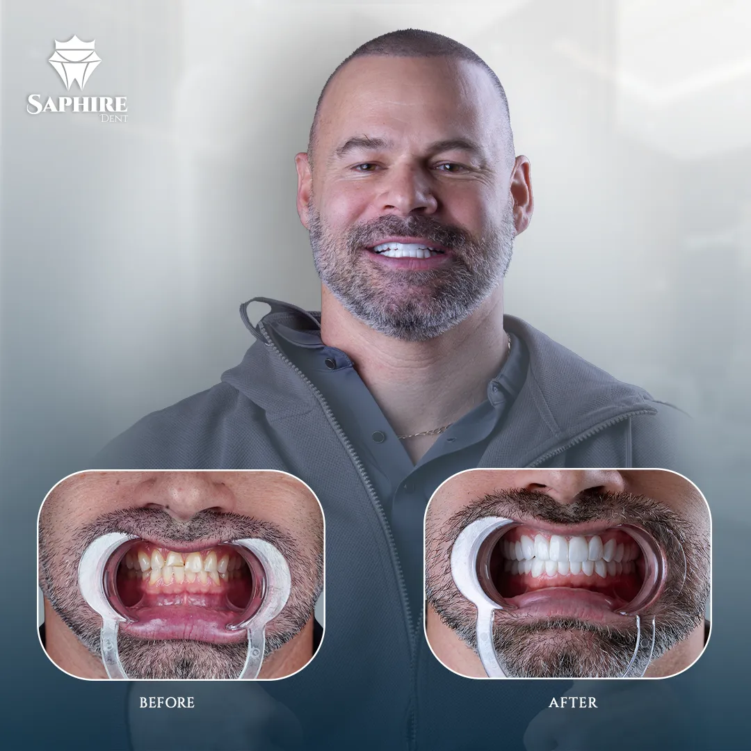 Before & After - Full Arch Dental Implants