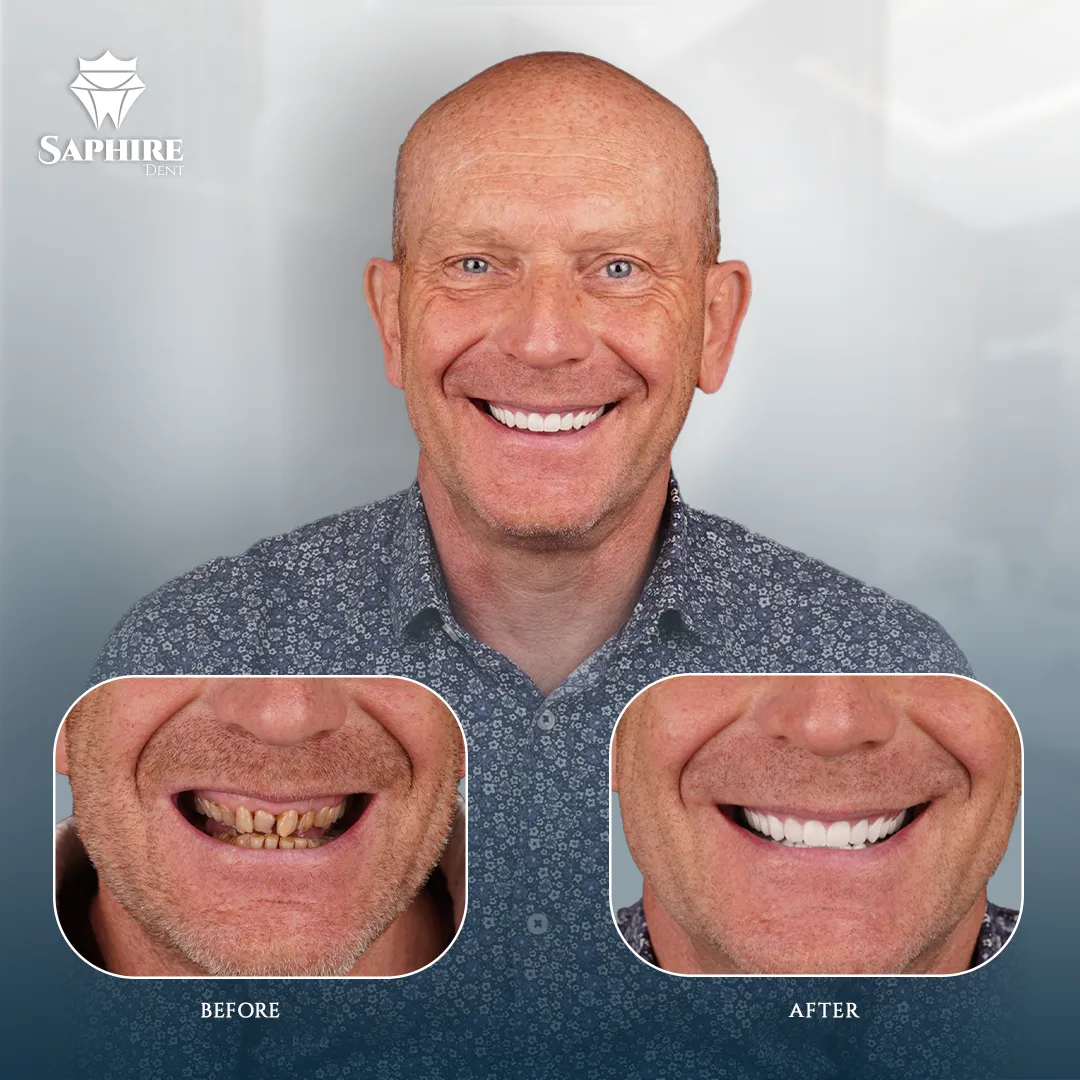 Before & After - Single Tooth Implant