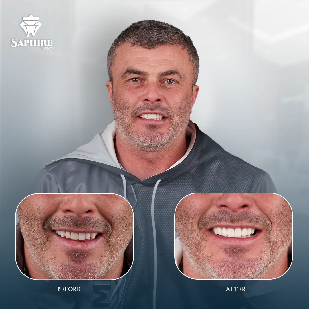 Before & After - Full Arch Dental Implants