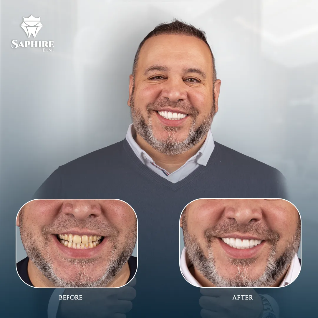 Before & After - Single Tooth Implant