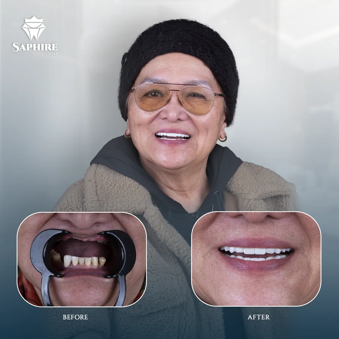 Before & After - Full Arch Dental Implants