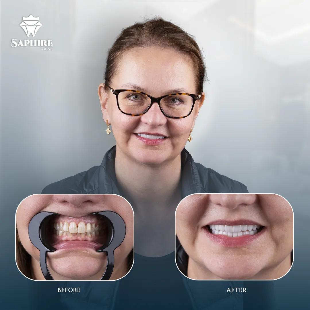 Before & After - Single Tooth Implant