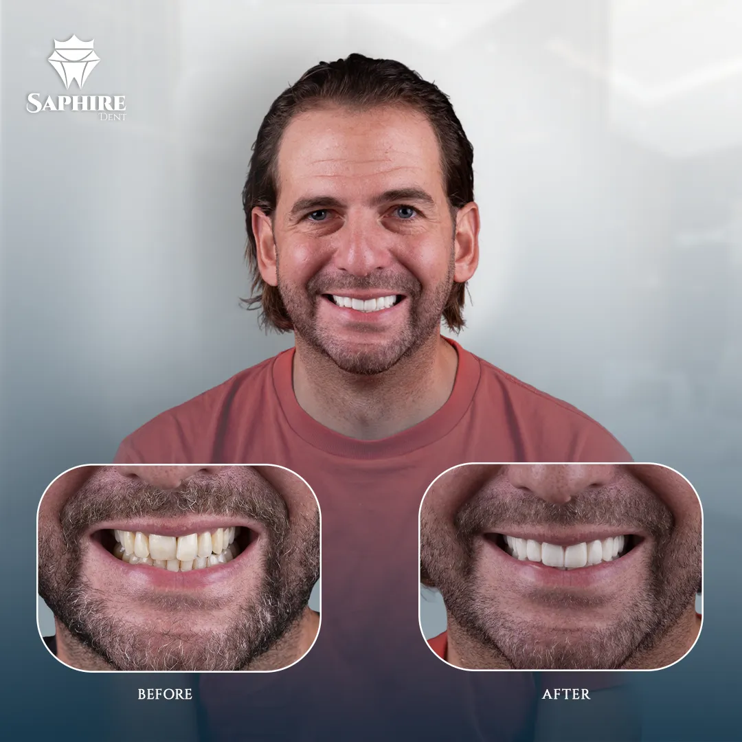 Before & After - Multiple Tooth Implants