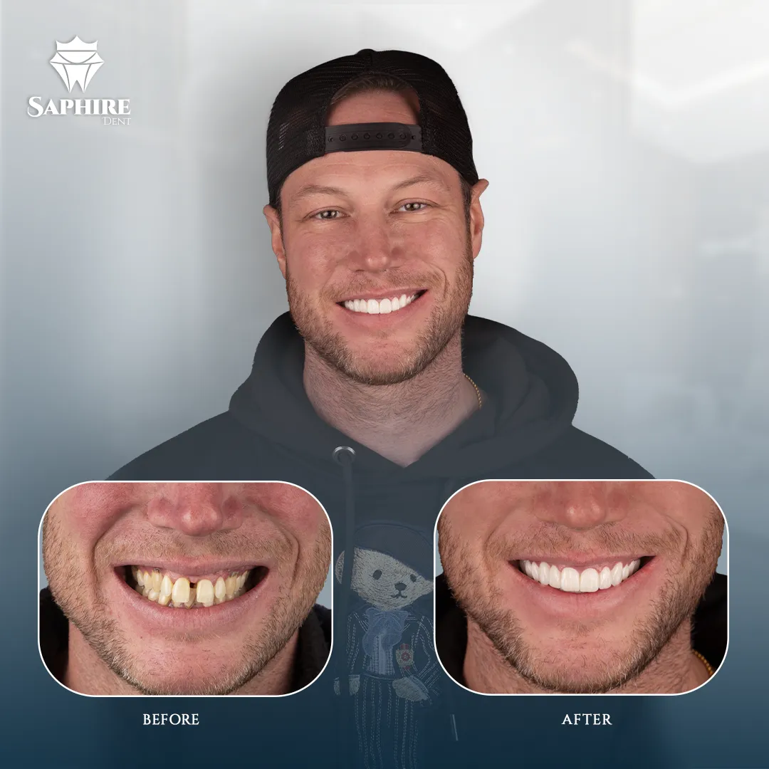 Before & After - Full Arch Dental Implants