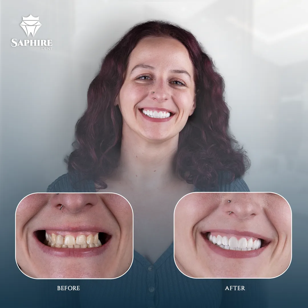 Before & After - Single Tooth Implant