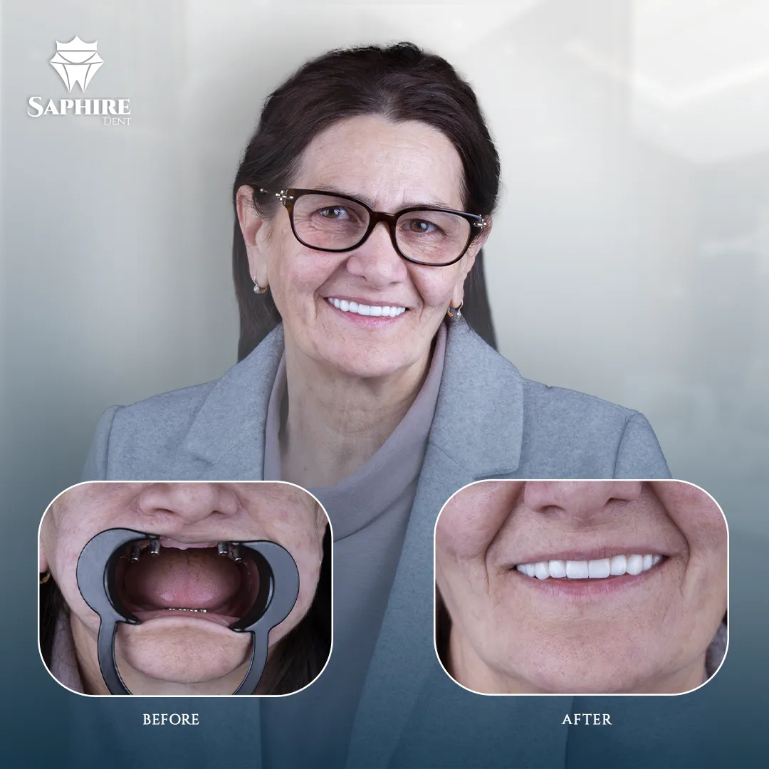 Before & After - Multiple Tooth Implants