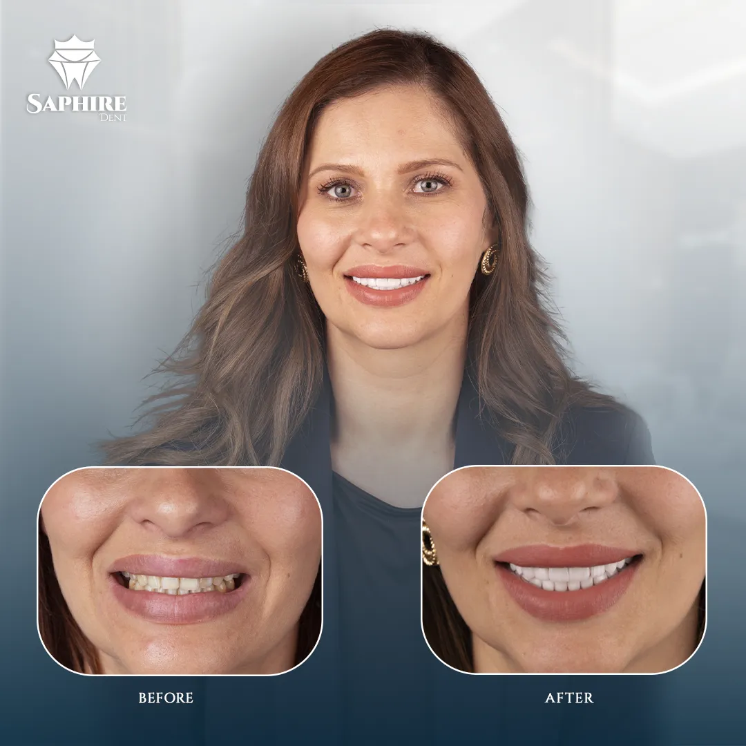 Before & After - Full Arch Dental Implants