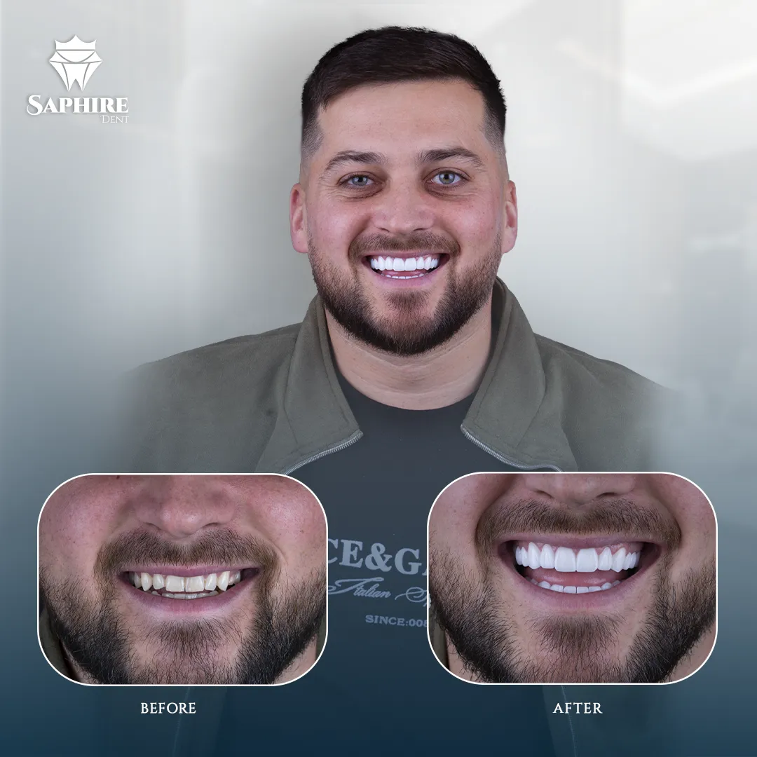 Before & After - Single Tooth Implant