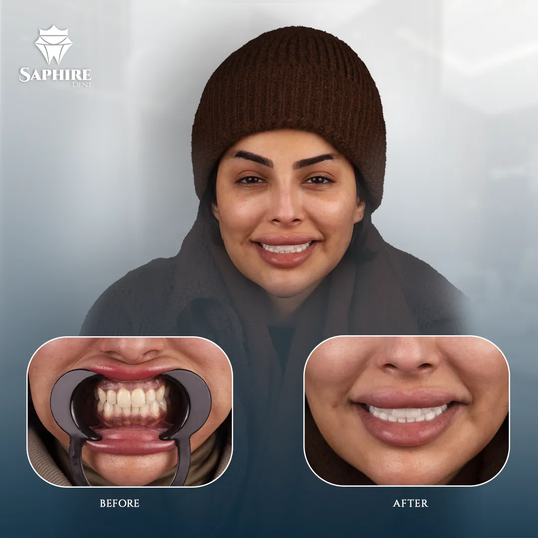Before & After - Single Tooth Implant