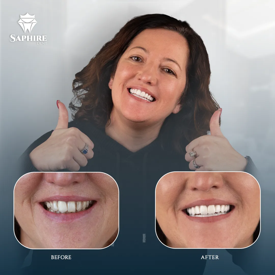 Before & After - Multiple Tooth Implants