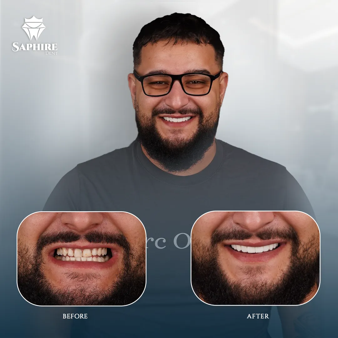 Before & After - Full Arch Dental Implants