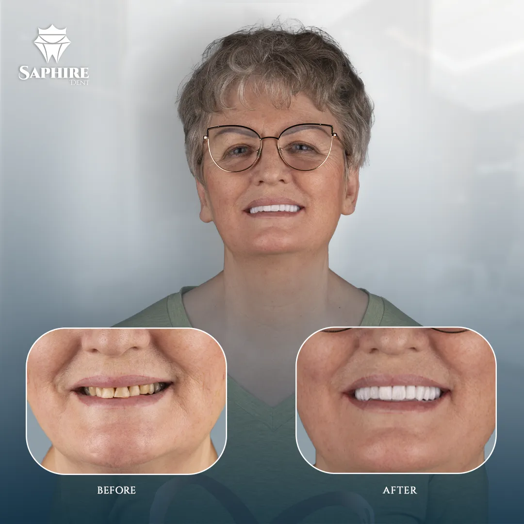 Before & After - Single Tooth Implant