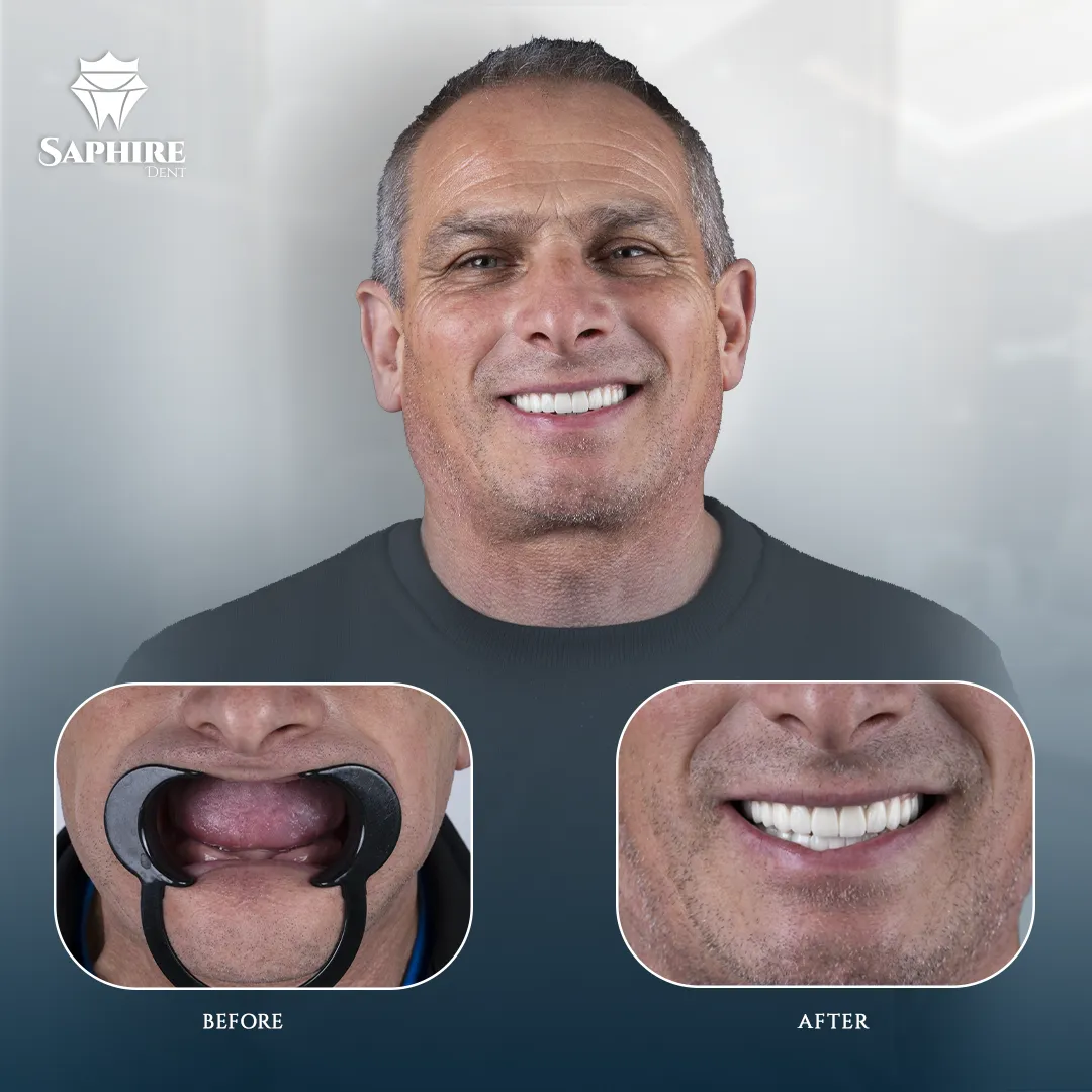 Before & After - Multiple Tooth Implants
