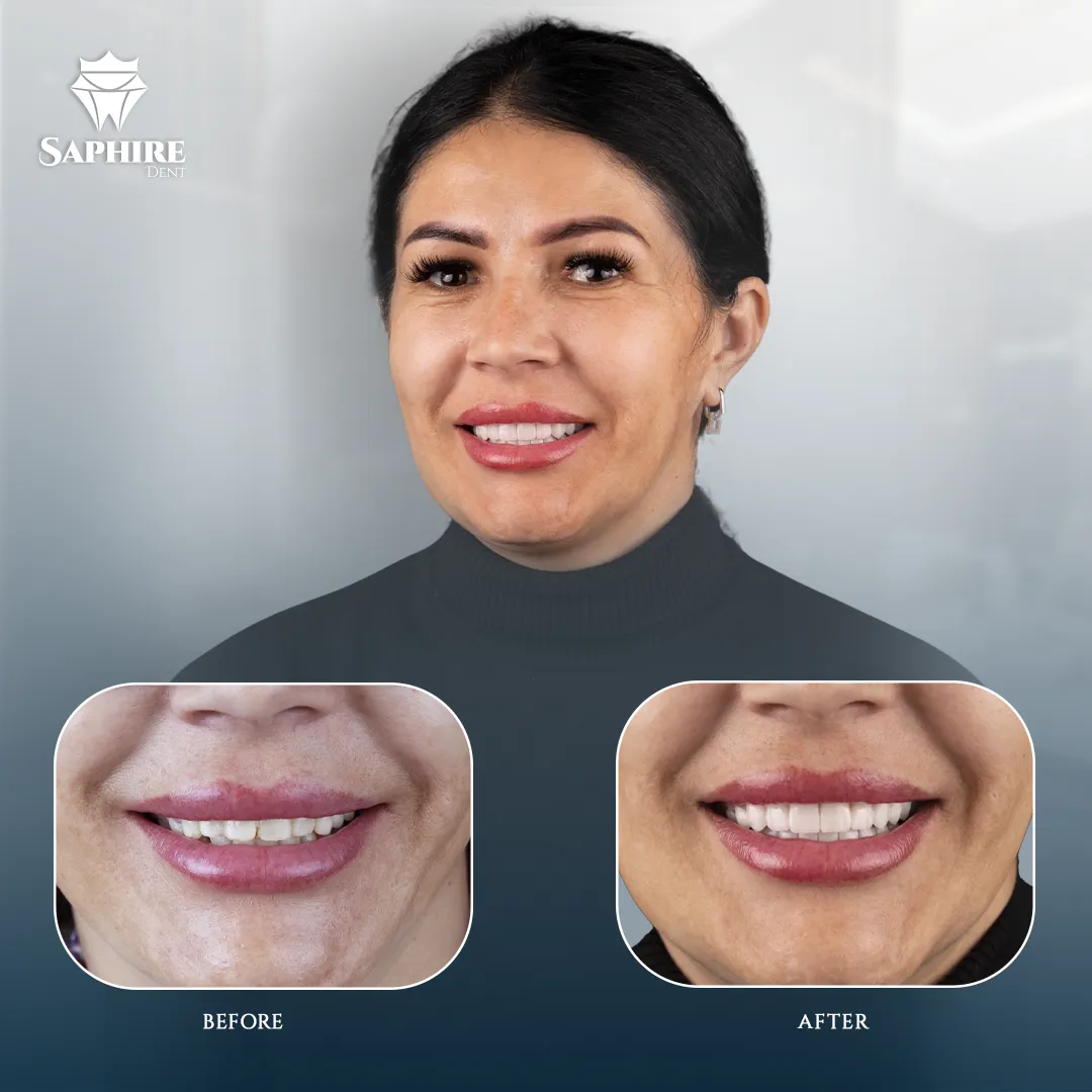 Before & After - Dental Transformation 2