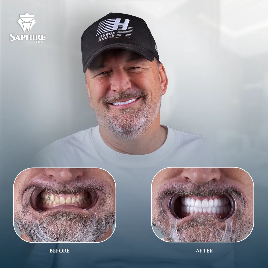 Before & After - Dental Transformation 3