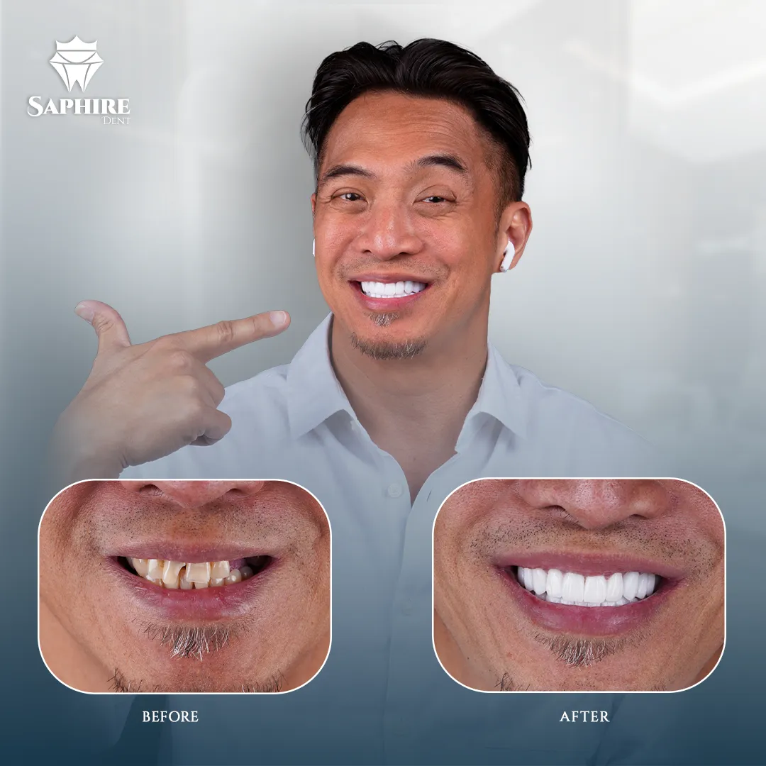 Before & After - Dental Transformation 4