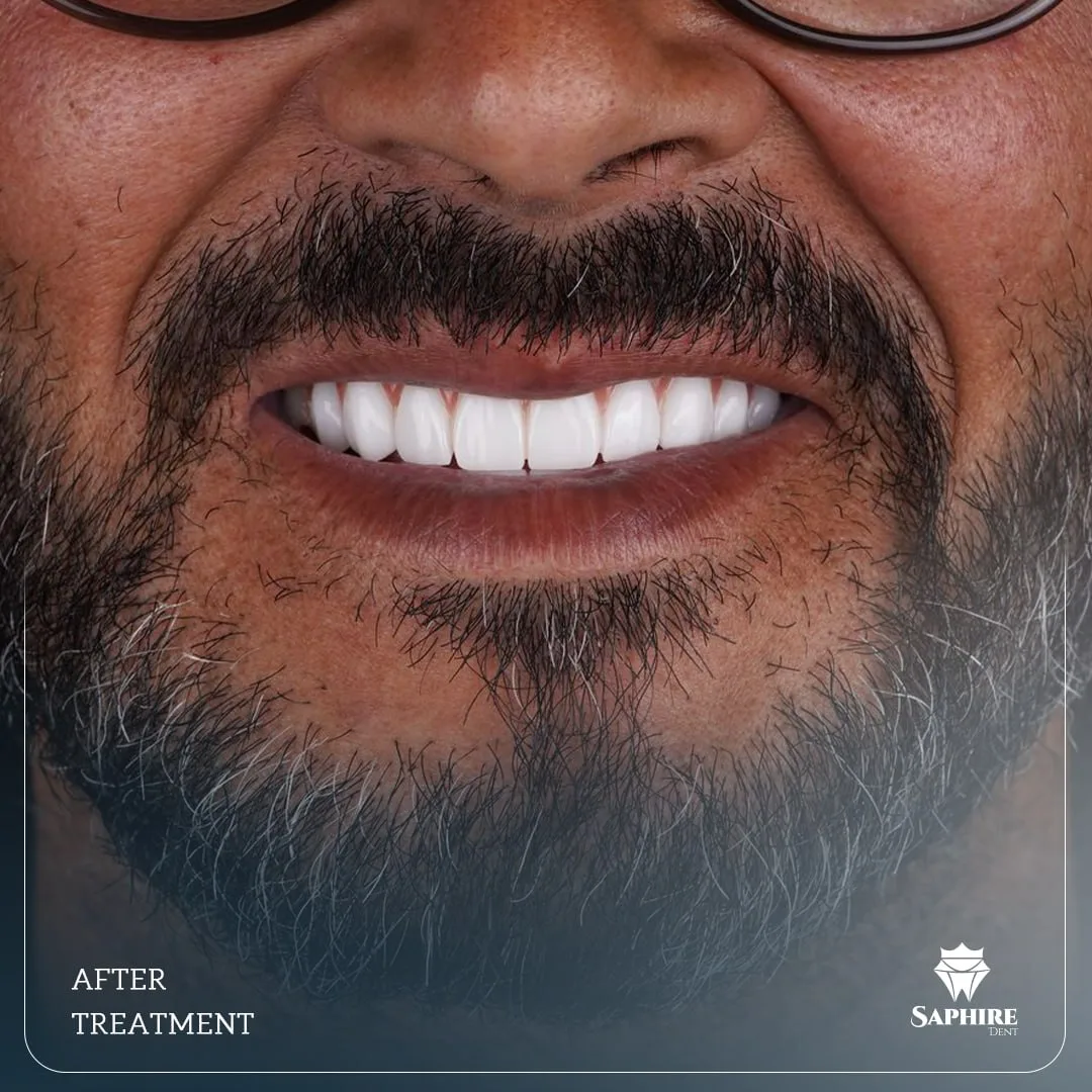 Implants