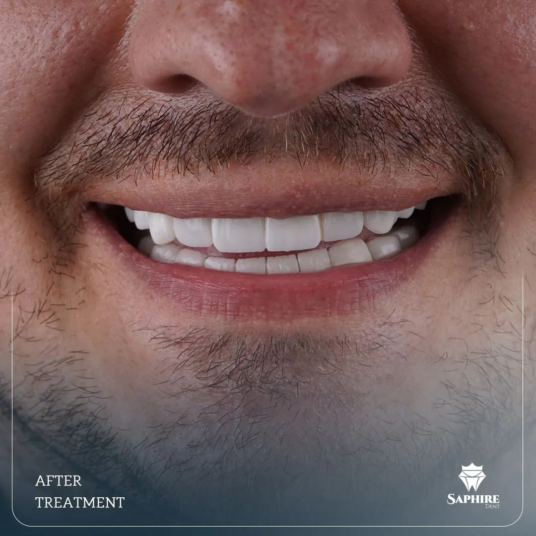 Implants