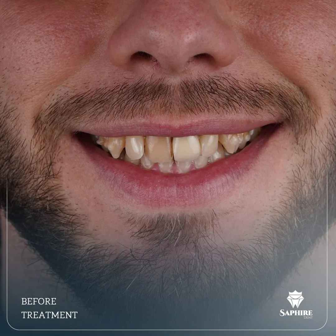 Before treatment