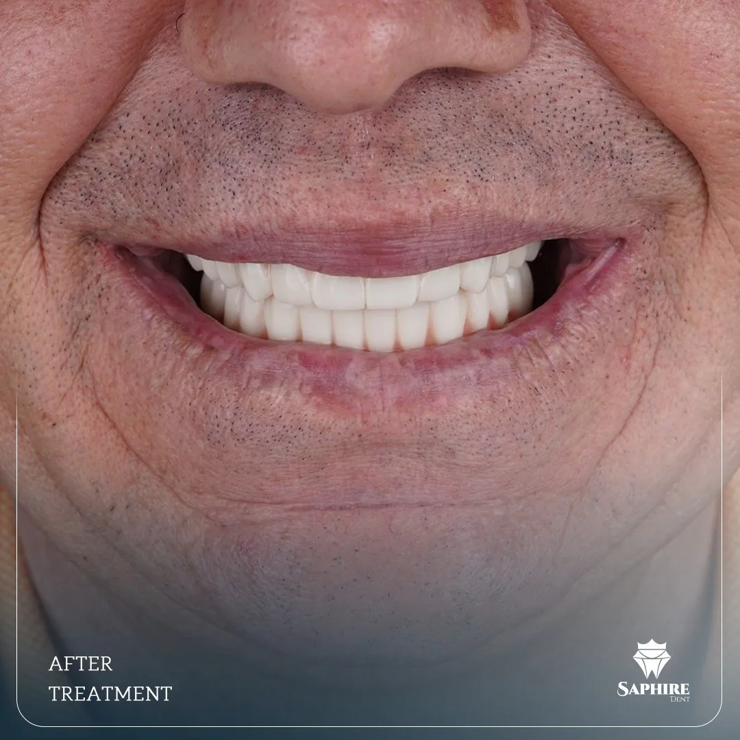 Full Mouth