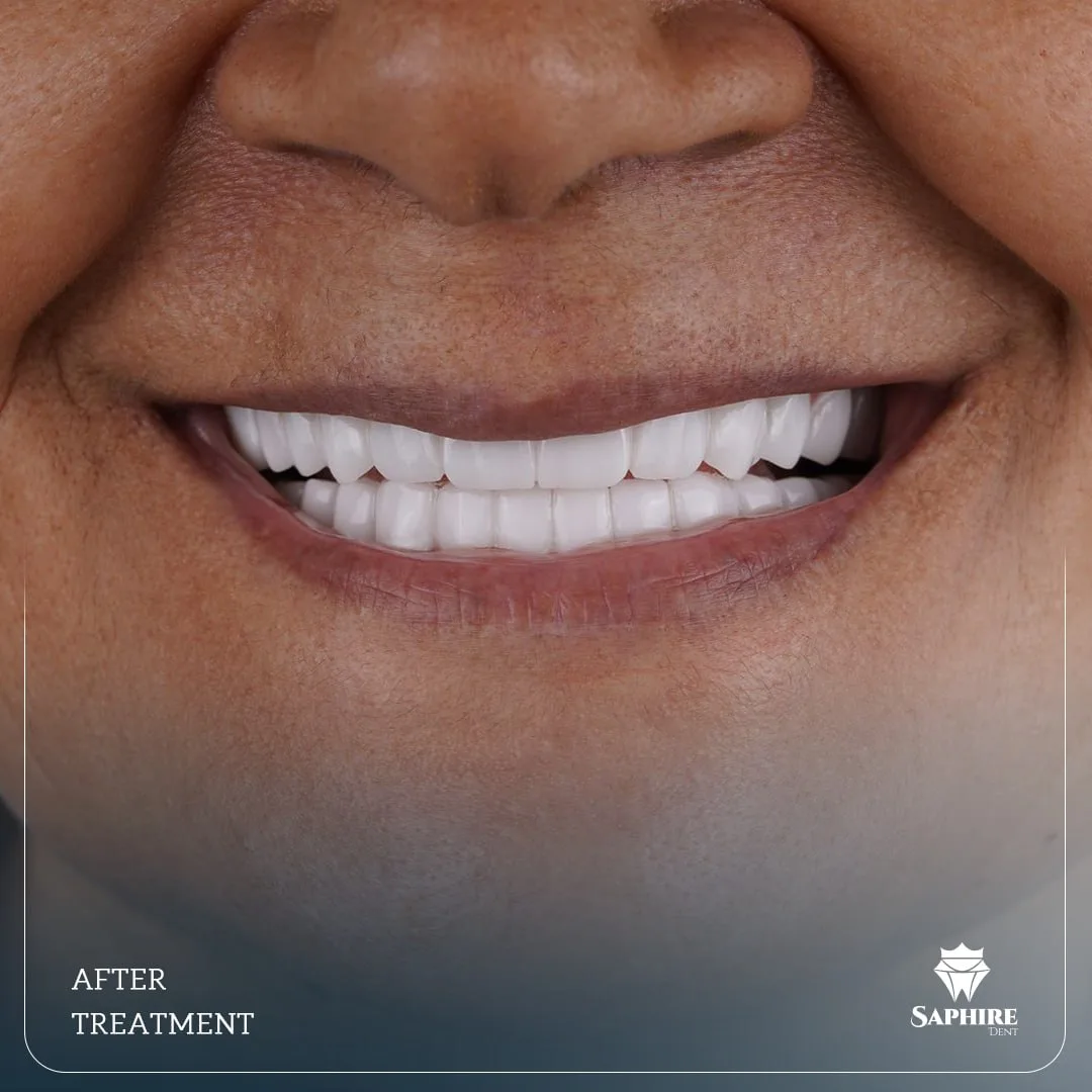 Veneers