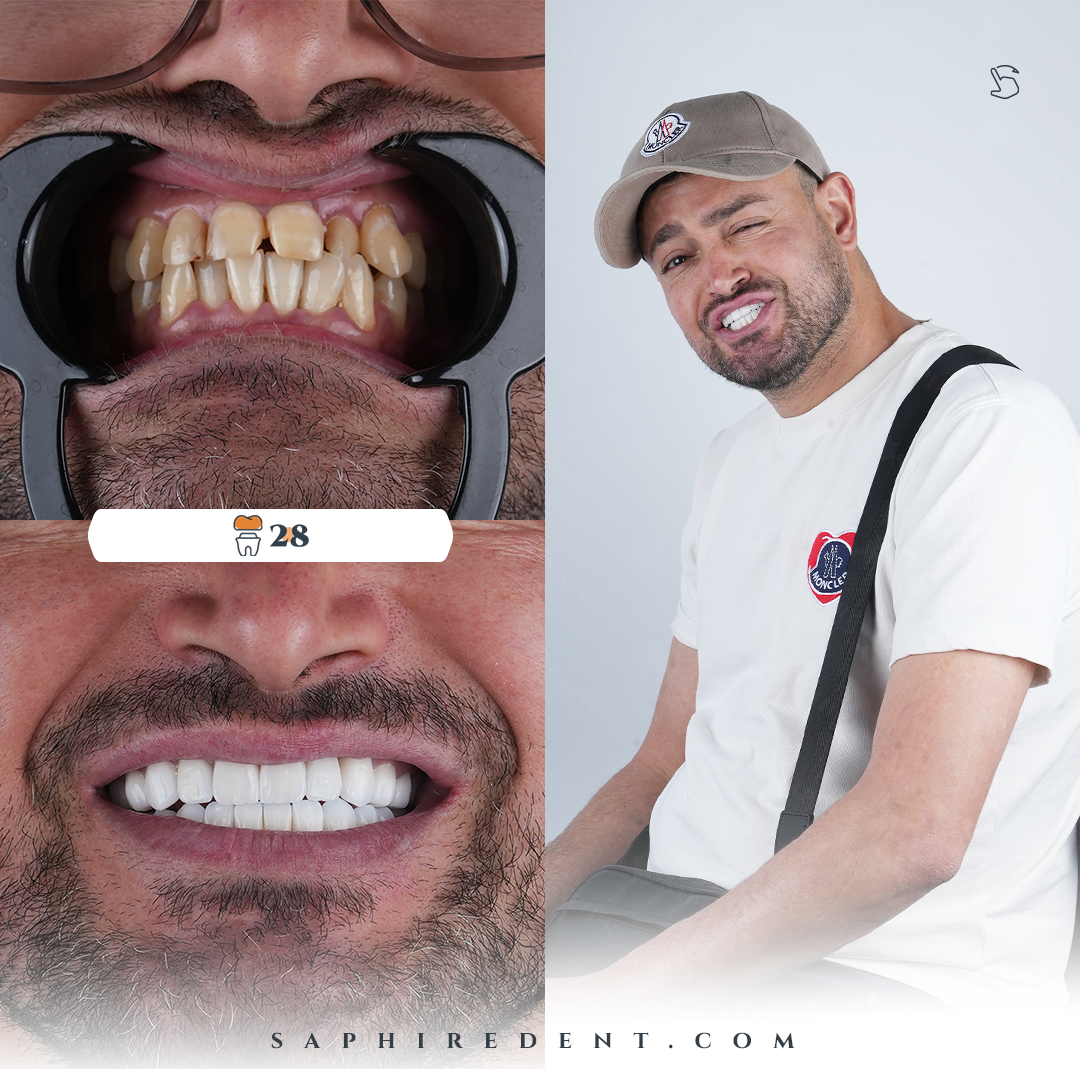 veneers.transformation