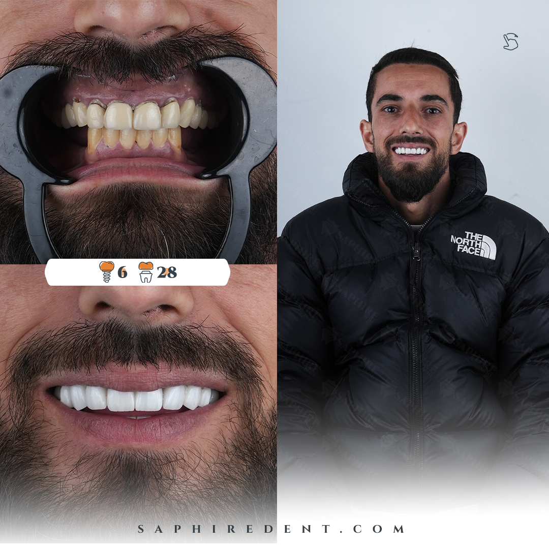 All-on-4 Diş İmplantları - Önce ve Sonra Sonuçları 4