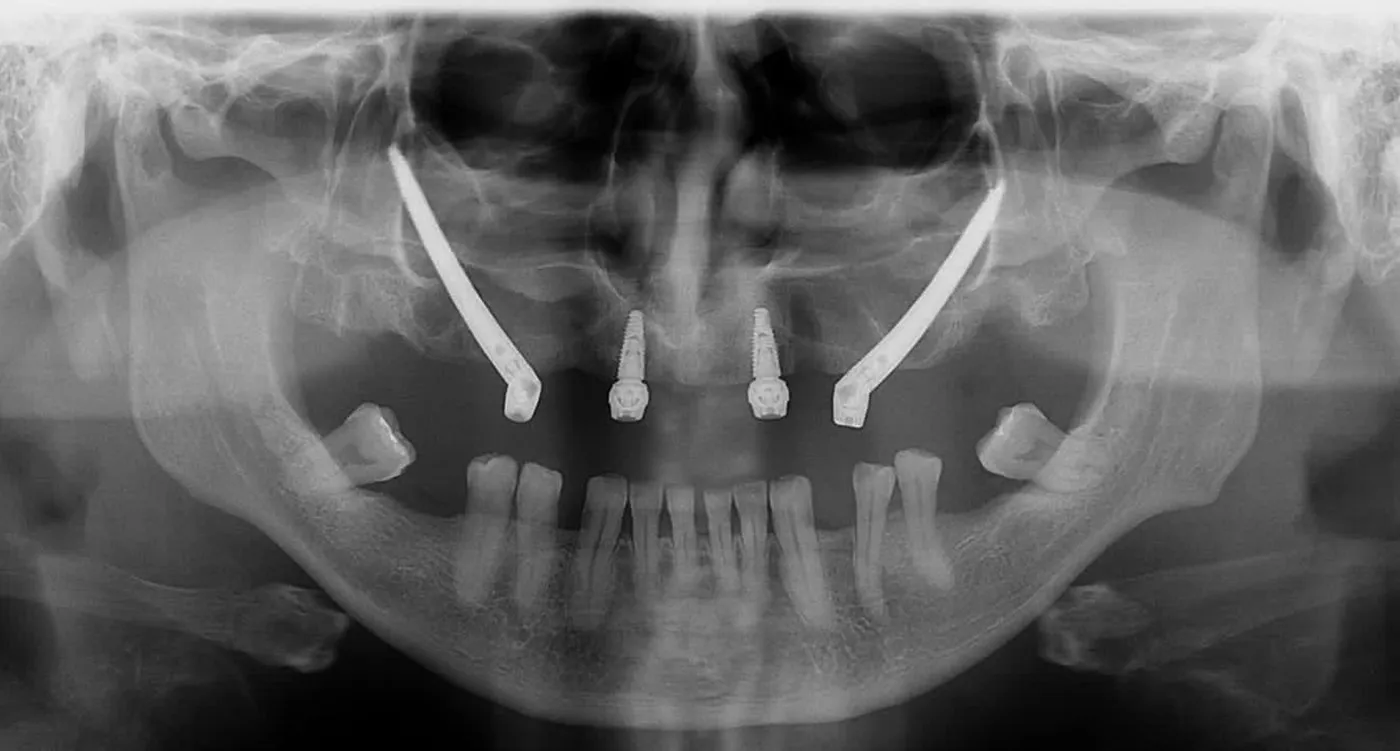 Zygomatic & anterior implants