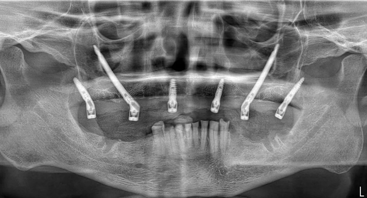 Full-arch zygomatic X-ray