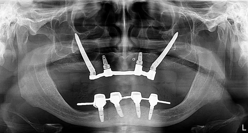 Post-op panoramic X-ray