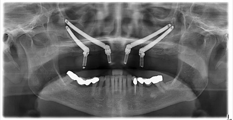 Zygomatic implants in the cheekbone