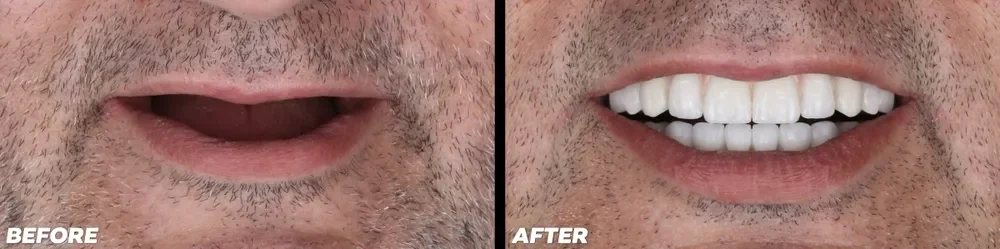 Why Everyone is Going to Turkey for Dental Implants