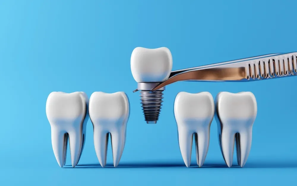 هل زراعة الأسنان تستحق الاستثمار؟ دليل شامل للمرضى الدوليين